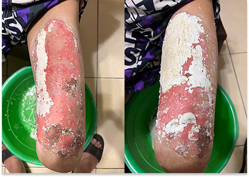 大腿腳燙傷使用見證